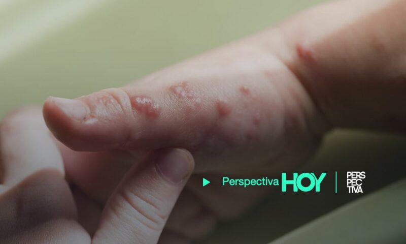 Viruela del mono: Salud emite alerta en fronteras de Guatemala