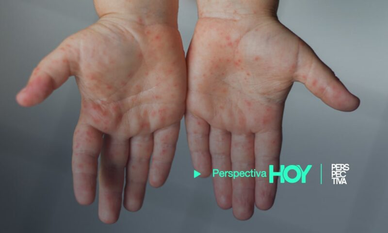 Viruela del mono: Argentina confirma primer caso en América Latina