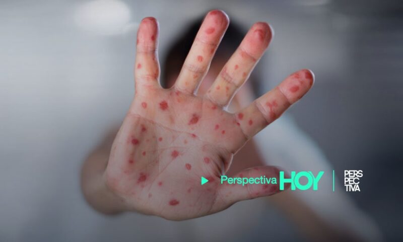 Viruela de mono: ¿Cuáles son los síntomas y riesgos para la salud?